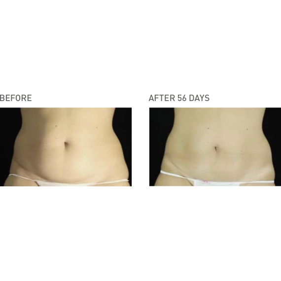 ANTI-CELLULITE FAT-LOSS BODY Zsírégető testápoló krém