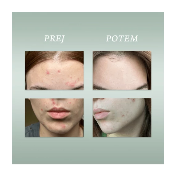 PURE SKIN SOLUTION Pattanások elleni koncentrátum spray arcra és testre