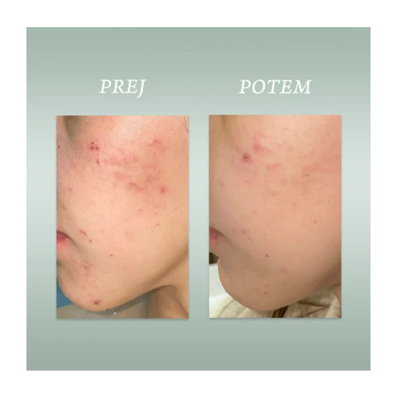 PURE SKIN SOLUTION Tisztítóhab zsíros, tisztátalan bőrre 