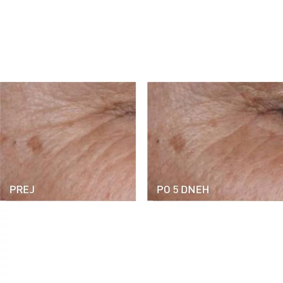 MULTIACTIVE Botulinum Toxin-Hatású Peptides SHOT