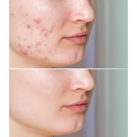 MULTIACTIVE Szalicilsavas BHA SHOT