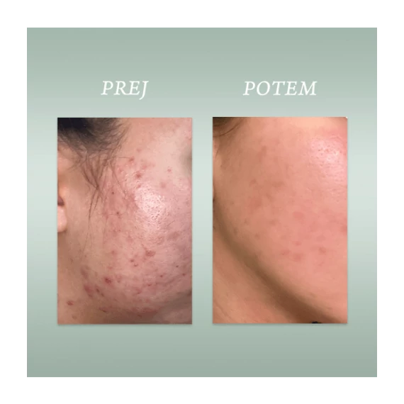 PURE SKIN SOLUTION Ultra könnyű hidratáló krém, emulzió normál, zsíros, tisztátalan bőrre